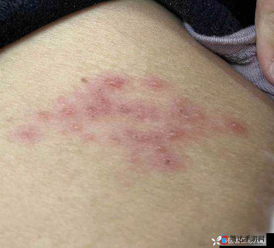 医院计划揭秘,接触性皮炎的详细症状介绍