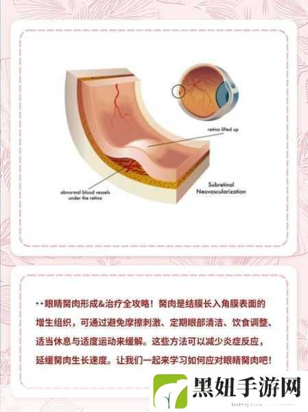 超级胬肉系统:1. 超级胬肉系统的全新应用与研究进展