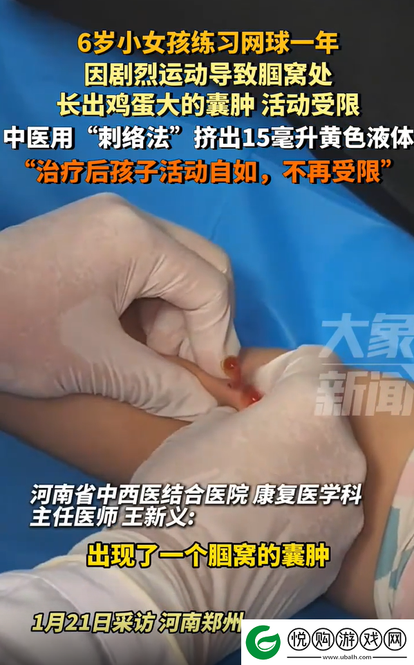 女童练球腘窝处长出大囊肿