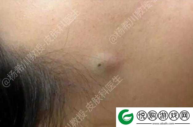 女性三角毛毛区长了个硬疙瘩